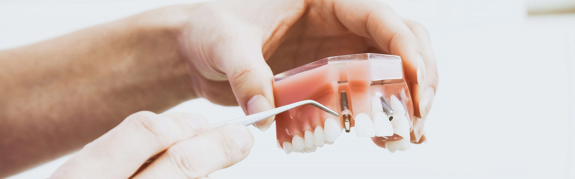 Dental implants Belgrade